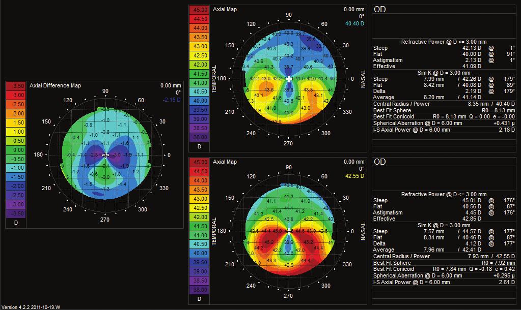 Comparative topographic map (bottom right) before and (upper right) after simultaneous conventional photorefractive keratectomy combined with corneal collagen cross-linking treatment for pellucid