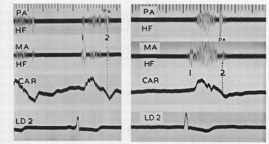 24 AN GRA Y sound is a delay that affects the whole of left ventricular activity.