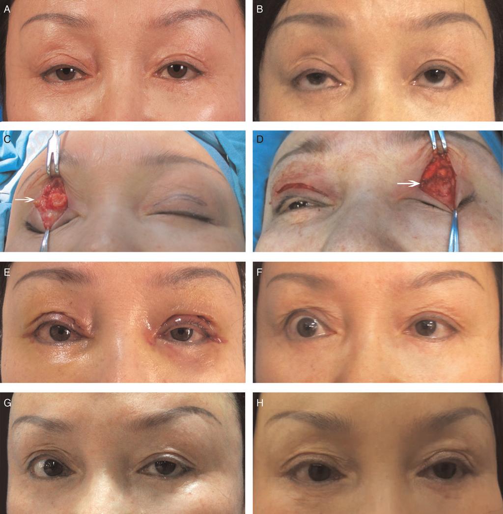 Li et al NP149 Figure 1. A 49-year-old female was referred with a 10-month history of bilateral ptosis after fat injection into upper eyelids.