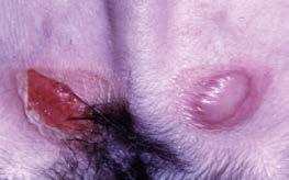 Reaction Vesicle or Bulla Epidermal Collarette Small, circumscribed fluid-filled elevation of the