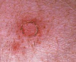 These are fragile and transient Circle of scale with a rim of surrounding erythema Pustules typically