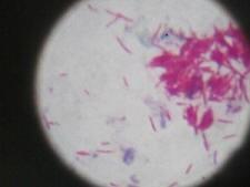 Figure 3 Skin smear stained with modified acid fast stain showing multiple acid fast solid
