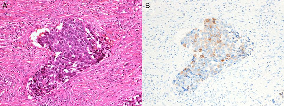 Jpn J Clin Oncol, 2015, Vol. 45, No. 4 333 Figure 7. Case 7: squamous cell carcinoma with neuroendocrine features. (A) H&E staining. (B) Synaptophysin. Figure 8.