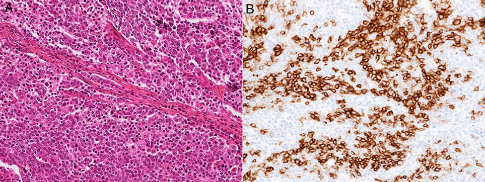 334 Neuroendocrine carcinoma in the head and neck Figure 9. Case 9: undifferentiated carcinoma with neuroendocrine features. (A) H&E staining. (B) CD56.