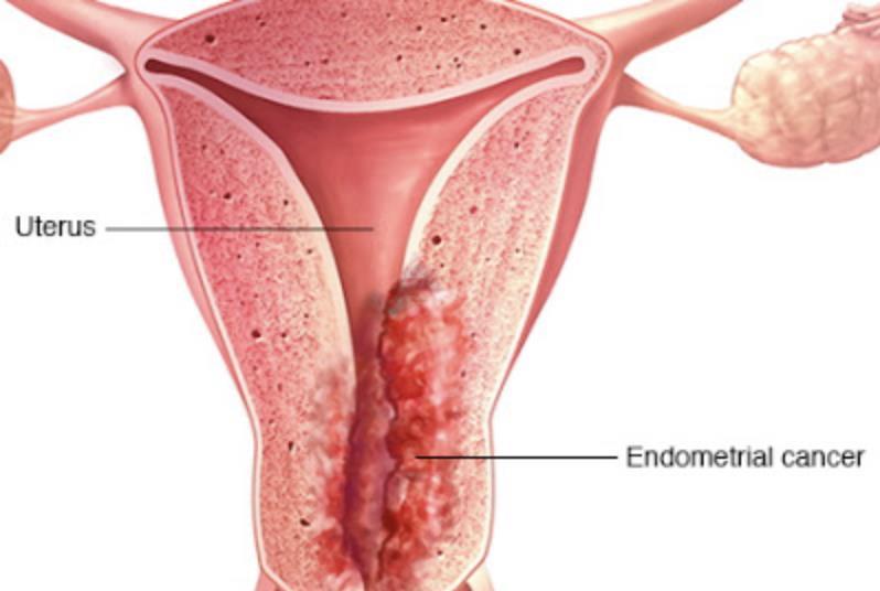 Uterine Can You Prevent It?
