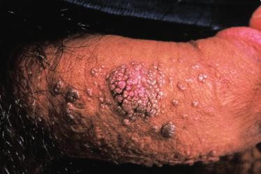 warts may also manifest as dome-shaped, usually fleshcoloured papules; flat warts are flat-topped papules which may vary in colour from pink-red to reddish-brown [1,3].