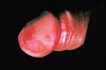 COMMON SKIN DISORDERS OF THE PENIS 501 spread crusting and psoriasis-like scaling, especially around and under the nails. Crusts and scales contains tremendous numbers of mites.