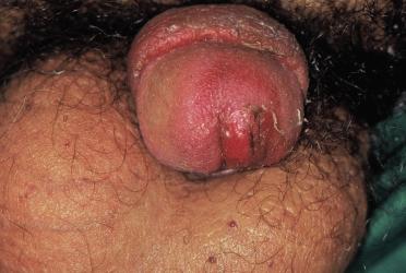 COMMON SKIN DISORDERS OF THE PENIS 503 Allergic and irritant dermatitis Clinically, genital allergic contact dermatitis is characterized by erythema and marked oedema and, in time, with