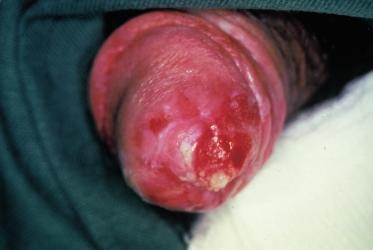 glans penis or the inner side of the foreskin [1]. An individual lesion may be 10 15 mm in diameter, and solitary or multiple lesions occur; they are usually bright red, glistening and not tender.