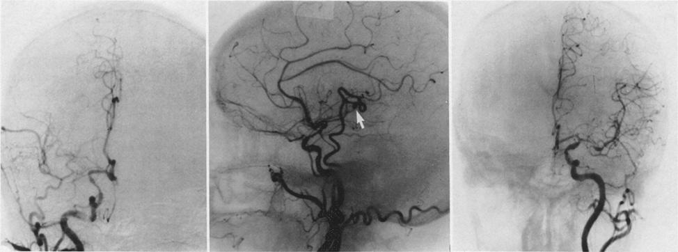 Extracranial-intracranial arterial bypass and for month to 4 years (average 26 months) in those with occlusion.