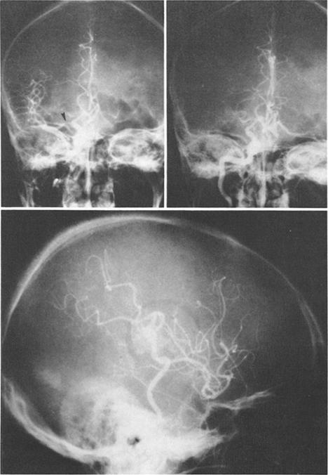 Upper Right: Angiogram, anteroposterior projection, obtained at the same time as the lateral projection (lower) showing progression of stenosis to a complete occlusion of the middle cerebral artery.