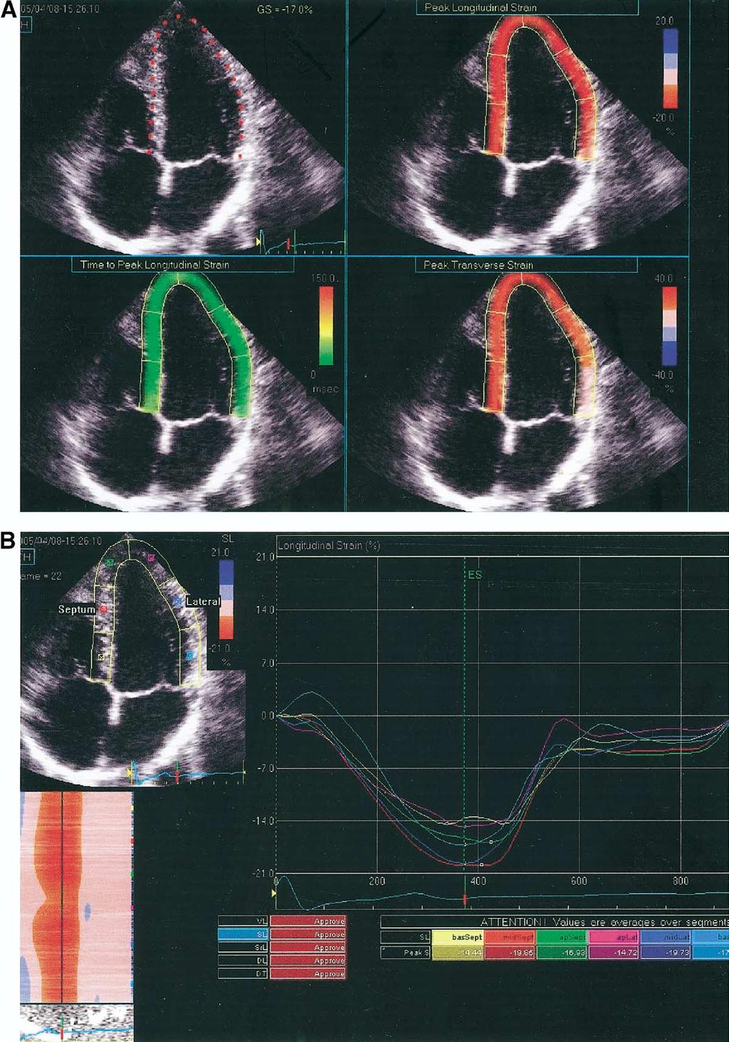 JACC Vol. 47, No. 6, 2006 March 21, 2006:1175 81 Serri et al. Strain in Hypertrophic Cardiomyopathy 1177 Figure 2.