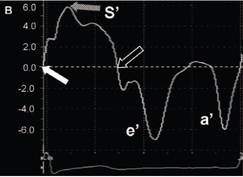 Abraham, Circulation 2007, 116:2597-2609 Abraham, Circulation 2007, 116:2597-2609 Tissue velocity tracing tracks myocardial motion at the point of