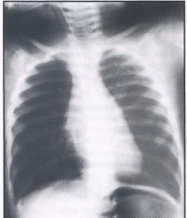 186 J INDIAN ASSOC PEDIATR SURG VOL 7 (OCT-DEC 2002) Fig 3 X-ray of a child with severe respiratory distress showing pneumoperitoneum. There was a foreign body in the right main bronchus.