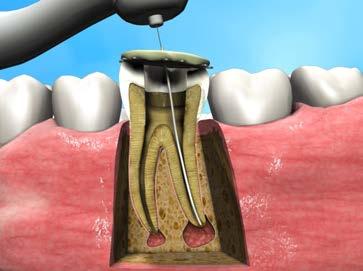 Regenerative Endodontics Stimulation vs. delivery!