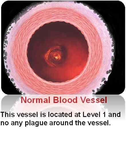 Normal Blood Vessel This vessel is located at Level 1 and no any plague around the vessel.
