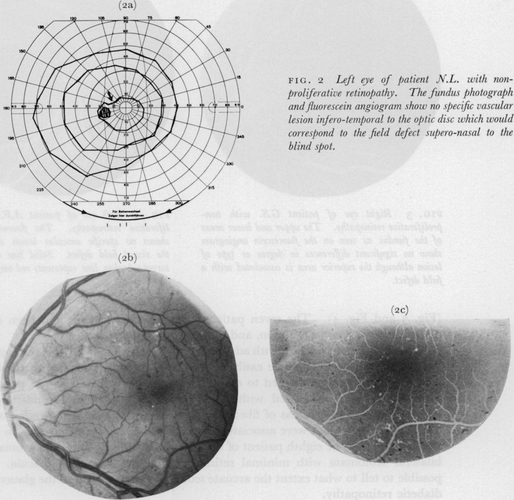 The fundus photograp)h andfluorescein angiogra nshow no specific vascular lesion