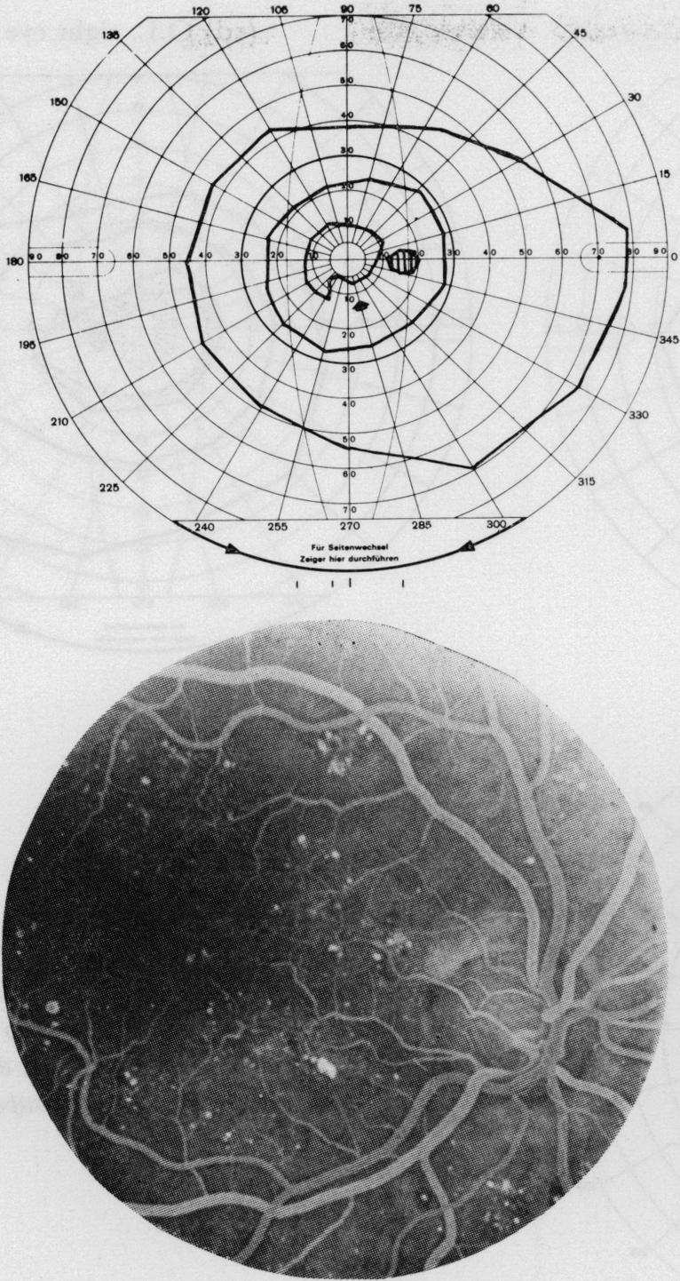 I86 K. I. Wisznia, T. W. Lieberman, and I. H. Leopold FIG. 3 Right eye of patient G.S. with non- FIG. 4 Left eye of patient A.F. with non-proproliferative retinopathy.