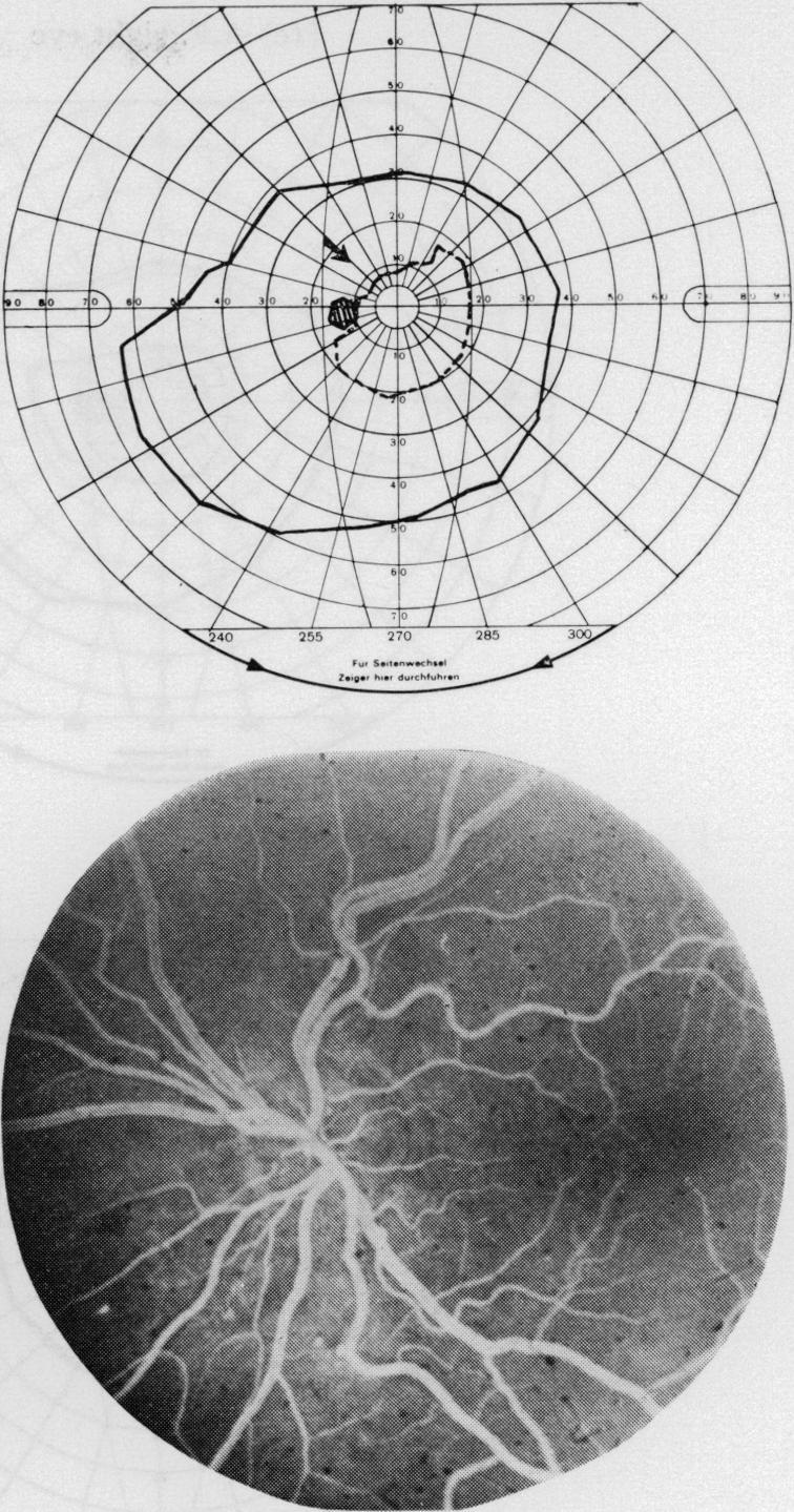 The fluorescein angiogram of the fundus as seen on the fluorescein angiogram shows no specific vascular lesion corresponding to show no signficant diferences in degree or type of the visual field