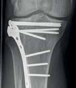 genex offers successful long-term outcomes across a range of surgical applications, including tibial plateau fractures and long-bone non-unions TIBIAL PLATEAU FRACTURE 3 * Patient presented with: