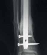 Outcome: At 15 months follow-up the fracture had healed and knee was stable, with a range of motion of 0 130. genex had completely absorbed.