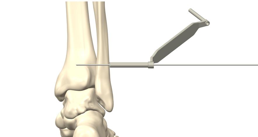 Surgical Technique 1. Drill the K-wire (IFS-9043) through all four cortices of fibula and tibia. The Drill sleeve (IFS- 9024) can be used to protect surrounding soft tissues during drilling.