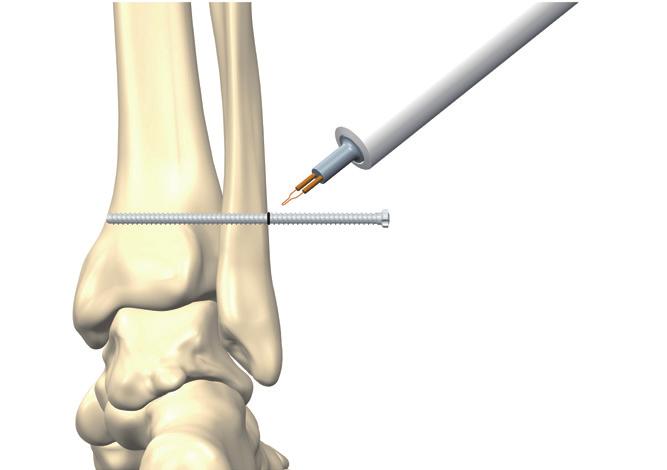 Surgical Technique 5. Mark the desired length measured from the tip of the screw (i.e. the length of the drill hole) on the screw shaft (OSC-4090) with a sterile marker.
