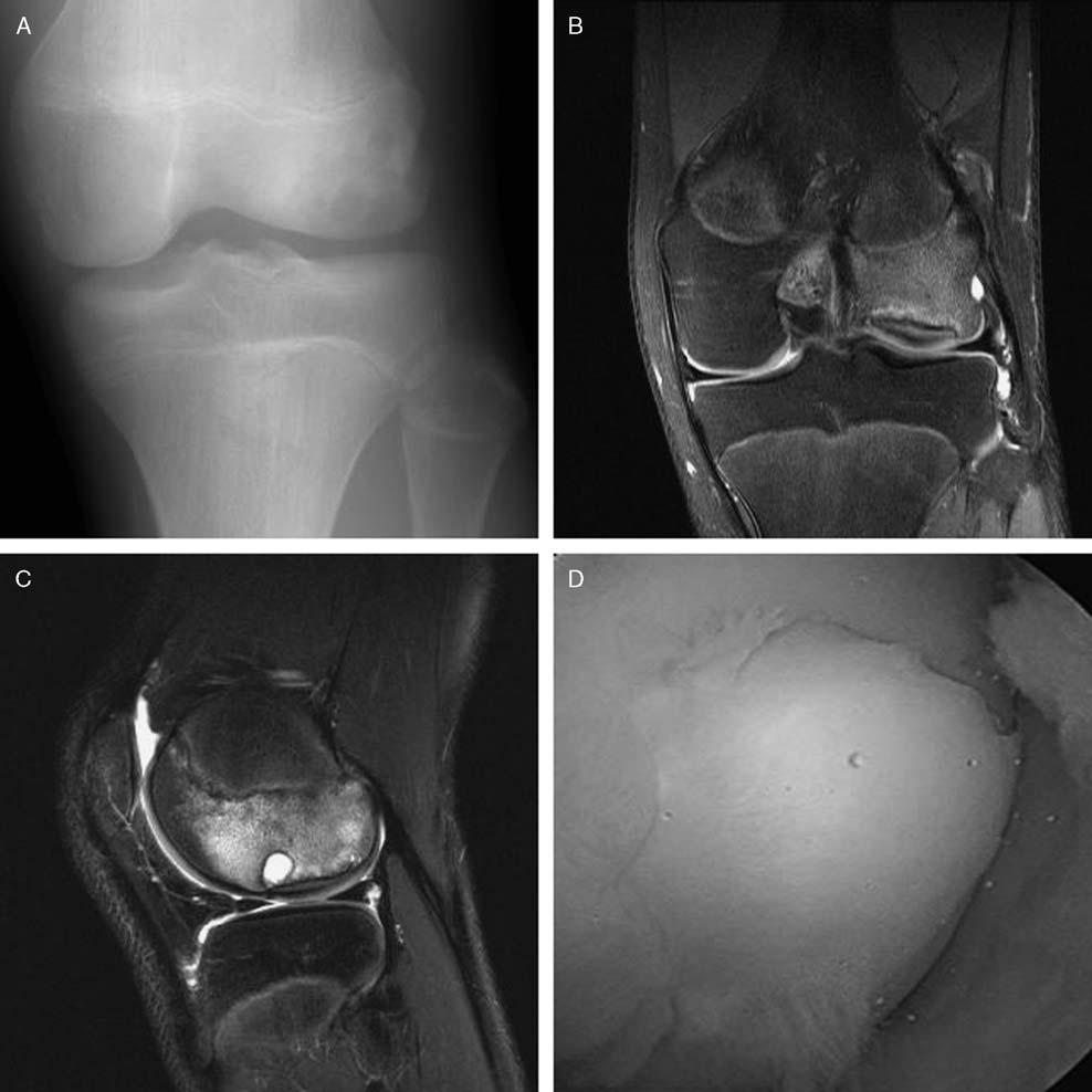 J Pediatr Orthop Volume 00, Number 00, 2015 Surgical Management of OCD of the Knee FIGURE 2.