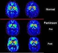 Parkinson s Disease The term Parkinsonism is used for symptoms of tremor, stiffness, and slowing of movement caused by loss of