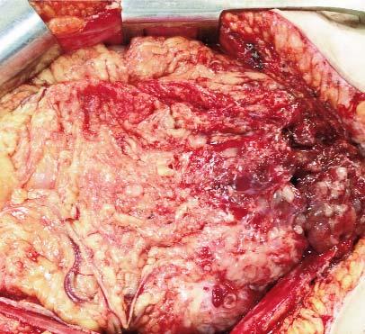 The local examination and Papsmear test excluded the presence of a cervical tumor while the endometrial biopsy revealed the presence of an endometrial stromal sarcoma.
