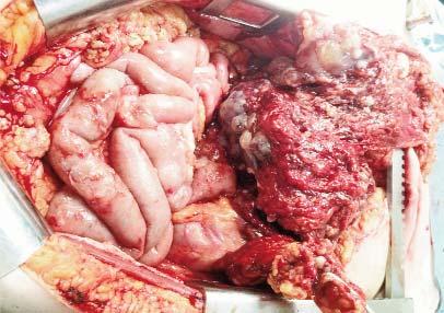 The patient was submitted to surgery and a total radical hysterectomy with bilateral adnexectomy, pelvic and para-aortic lymph node dissection was performed.