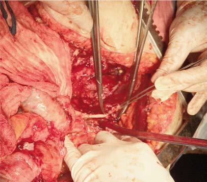 399 Figure 8. Dissection of the left external iliac artery the recurrent disease was pelvic alone in 51.5%,