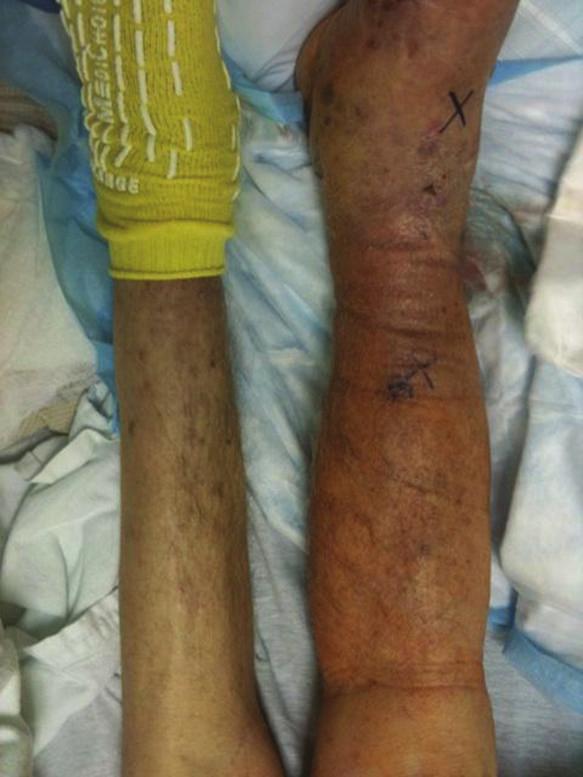2 Case Reports in Oncological Medicine (a) (b) (c) Figure 1: (a) Patient s right lower leg is seen here demonstrating the lymphedema compared to the opposite left leg.
