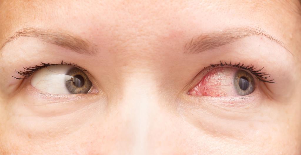 Chapter 1: Introduction Irritation of the eyes and eyelids comes in many forms: itching, redness, swelling, dilated blood vessels (bloodshot eyes), dryness, blurred vision, soreness, loose or flaky