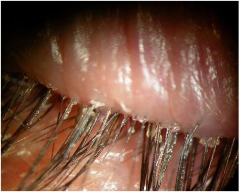 Chapter 4: How Eye Mites are Diagnosed?