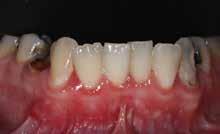 3: The preoperative right lateral view shows evidence of the failing mesial/occlusal/distal (MOD)