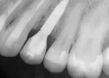 preparation and refinement of teeth #2 through #14 was performed and final