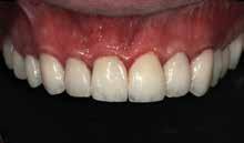 26: An incisal edge cutback was performed to allow aesthetic characterization,
