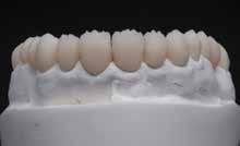 max crown restorations were delivered, as well as the other definitive maxillary