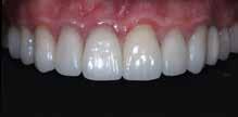 In particular, the sixth appointment was dedicated to final preparations and impression taking on teeth #18 through #31. Two weeks later, the definitive IPS E.