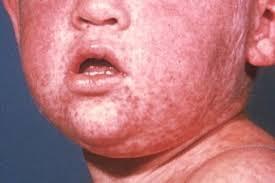 Immunization in the United States Today Mumps, Measles, German