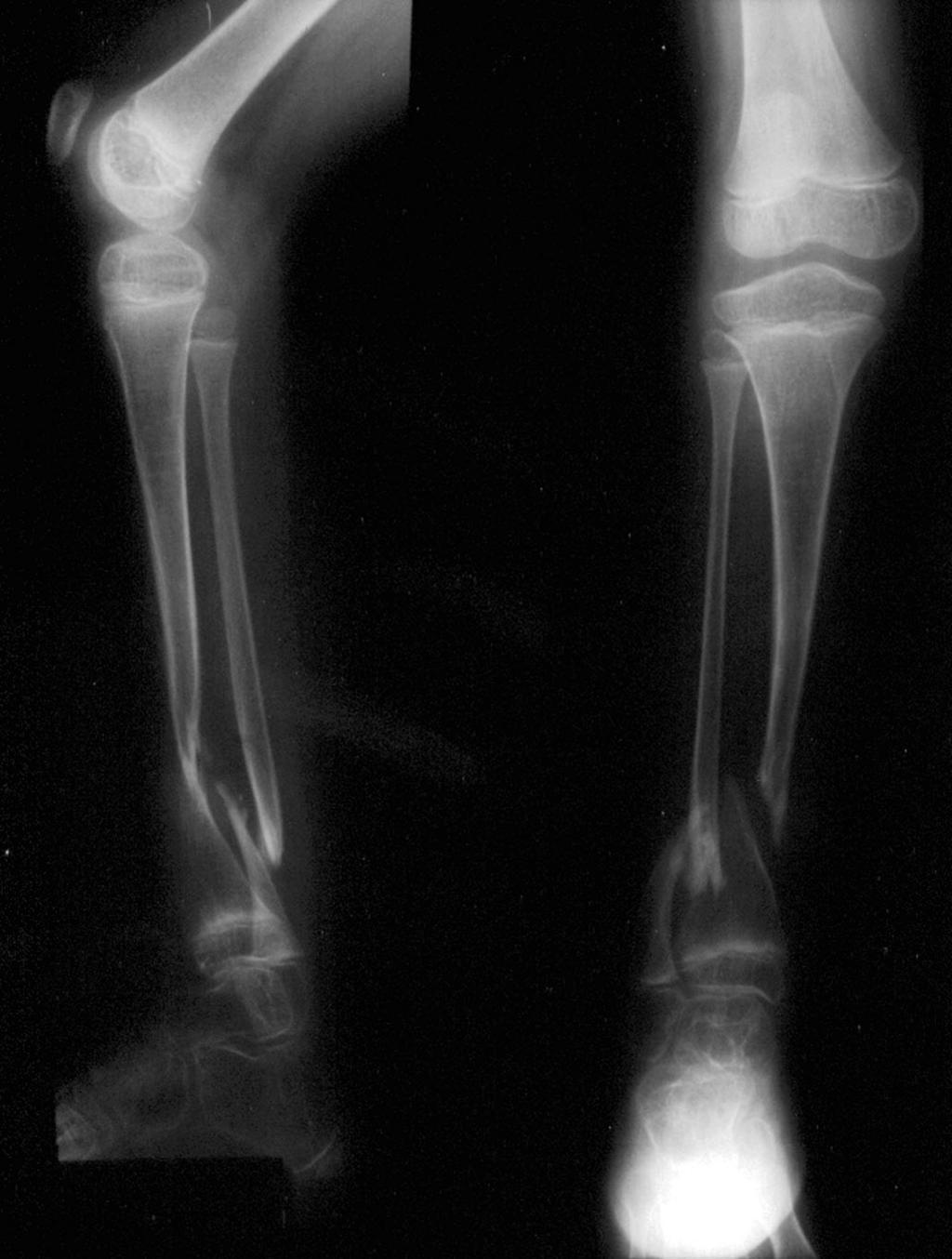 1190 removed in an attempt to regain ankle motion; all three patients sustained a refracture, which required repair of the pseudarthrosis and reinsertion of the rod (Table I).