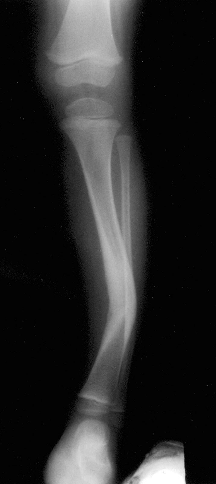 Ten patients had a fibular pseudarthrosis at the time of the intramedullary nailing of the tibia.