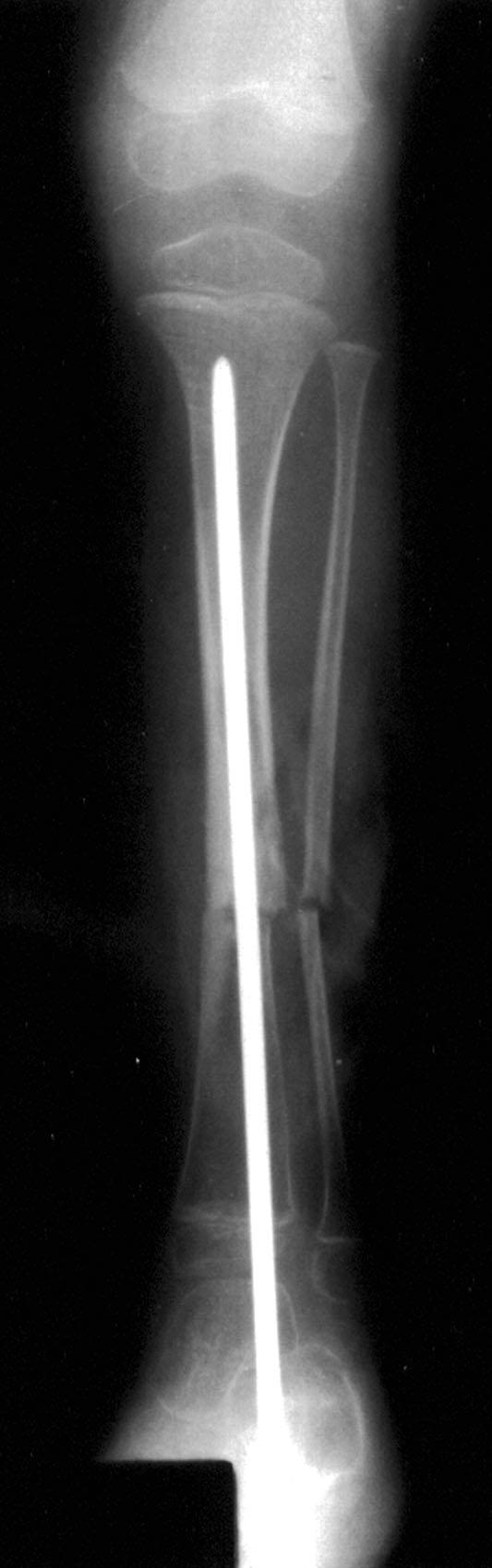 throsis preoperatively (six of ten patients), even when the fibular lesion had been excised and had subsequently united.