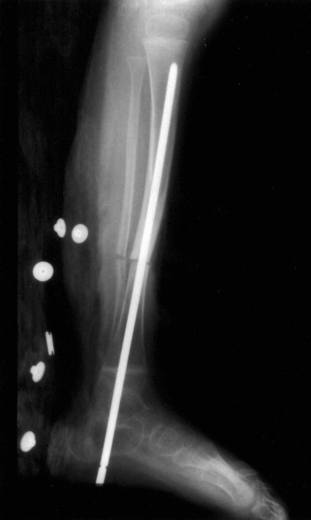 Of the eleven patients who had an intact fibula at the time of surgery, eight had a fibular osteotomy to aid in the alignment of the tibial fragments; of these eight patients, six had a refracture of