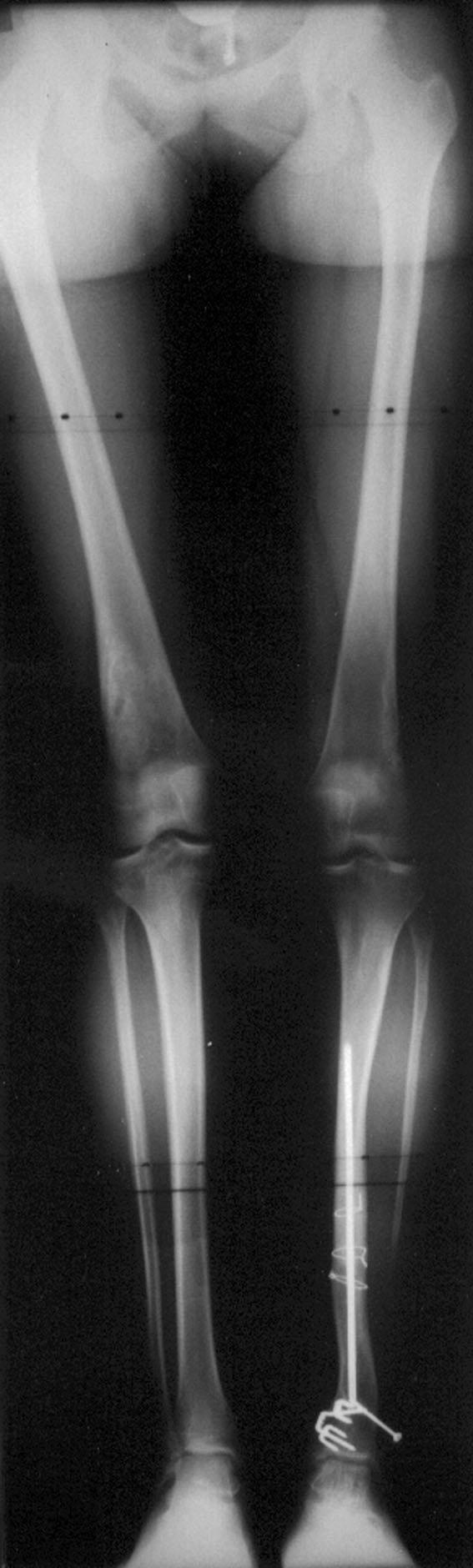 1193 Five patients required amputation because of chronic lower-extremity dysfunction: two, because of recurrent fracture nonunion; two, because of limb-length discrepancy; and one, because of