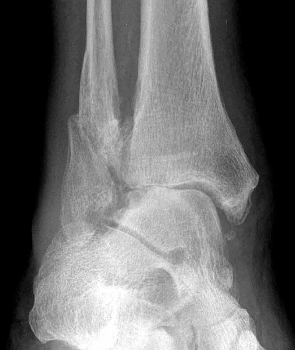 Tibiotalar Fusion: 62 YO Male CASE REPORT Case Overview» Post-Traumatic Injury/Deformity» 62 year old male with painful ankle joint» History of alcohol abuse» Patient has history of joint