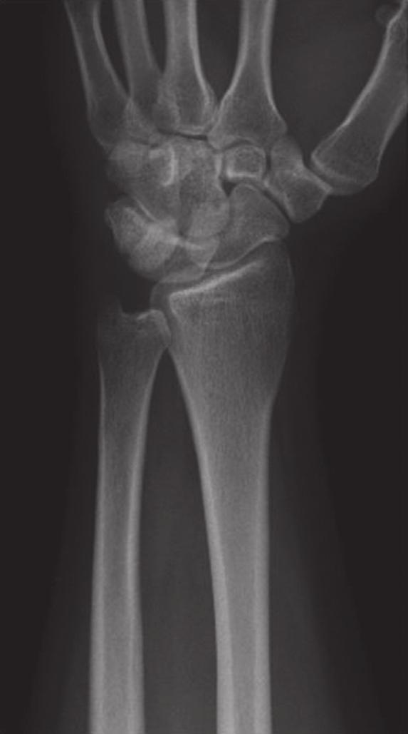 CaseReportsinOrthopedics 3 Figure 4: Photographs at 18 months postoperatively. The range of motion was equal to the contralateral side. Figure 5: Radiographs at 18 months postoperatively.