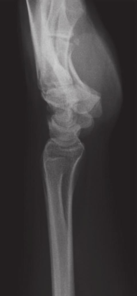 However, radiographs at week 5 postinjury showed displacement with shortening and eventual malunion at 2 months.