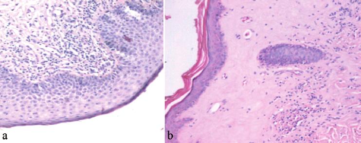 Concomitance for oral and genital lichen planus 435 Fig. 3. Histological features of (a) vulval lichen sclerosus and (b) genital lichen planus. Original magnification, a: 200, b: 100.